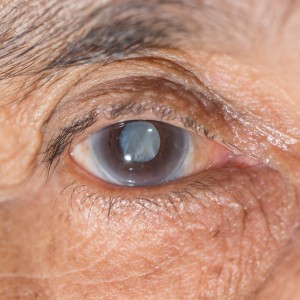 cataract-300x300