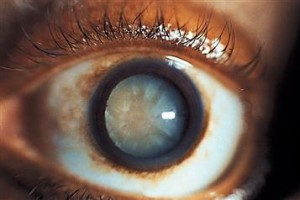 Cataract image courtesy of AAO (© American Academy of Ophthalmology)