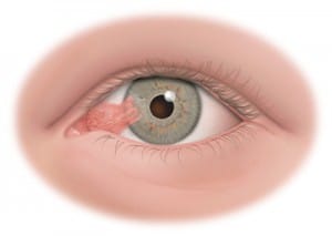 illustration of an eye with Pterygium