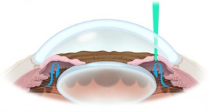 Drawing of Laser Treatment For Open-Angle Glaucoma
