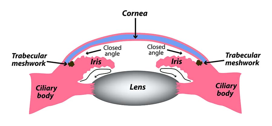 Closed angle glaucoma