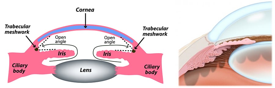 side diagram of an eye with symptoms of open angle glaucoma