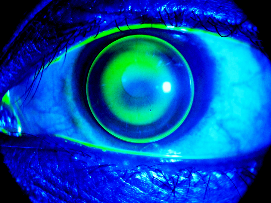 Picture of a Rgp contact lens that fits with an eye and viewing under cobalt blue light with fluorescence dye.