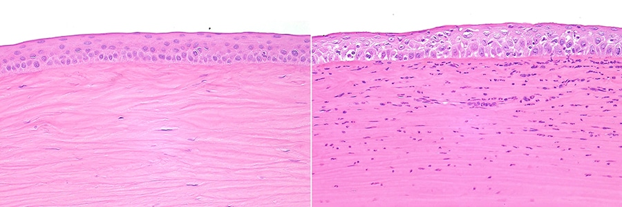 Corneal Erosion & Pterygium Eye Treatment Santa Rosa CA