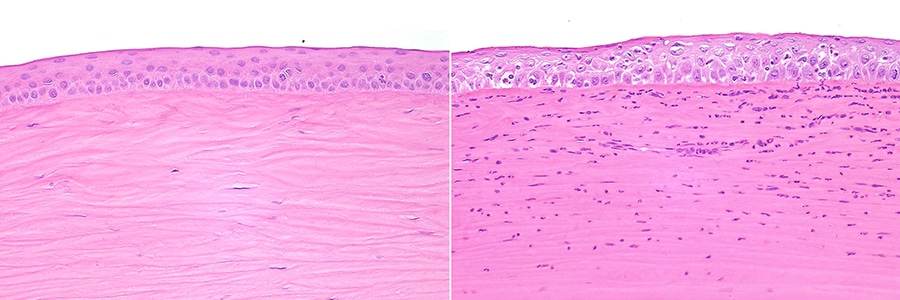 corneal erosion eye care institute santa rosa ca