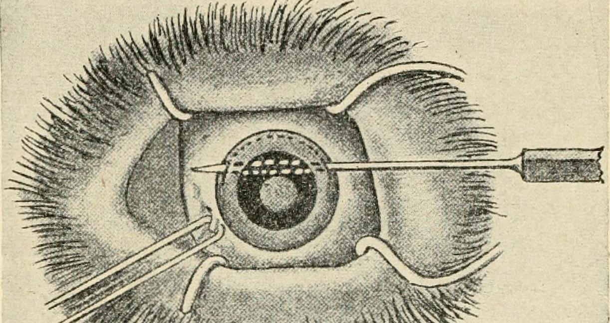 corenea incision