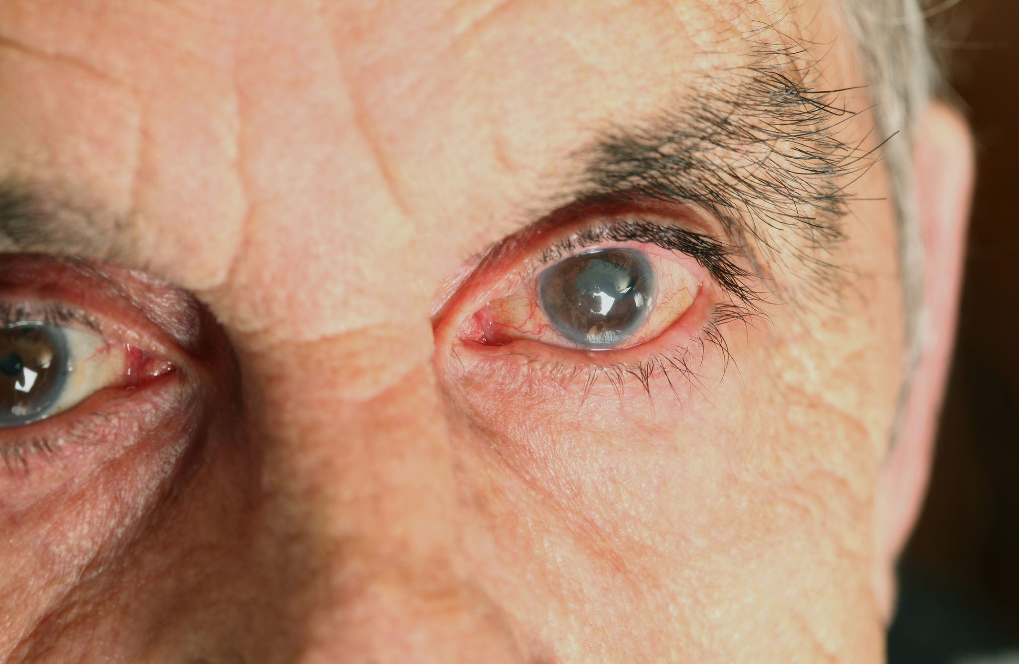 Man with cataracts in his eyes