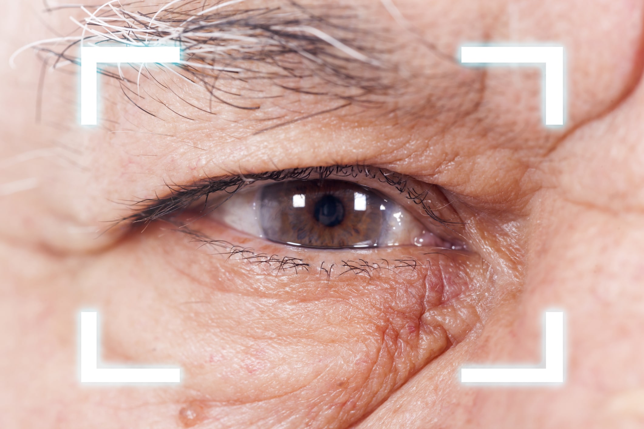 YAG Laser Capsulotomy Santa Rosa CA