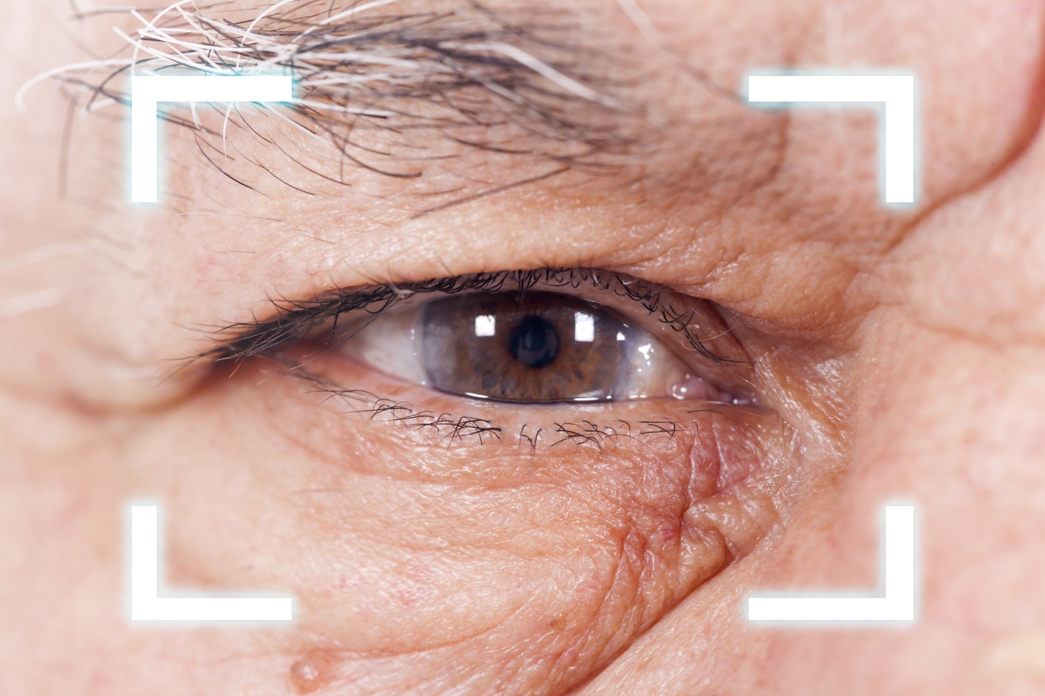 close view of man's eye with secondary cataracts