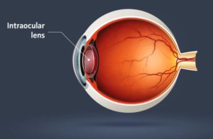 The anatomy of a human eyeball showing where an intraocular lens would be placed