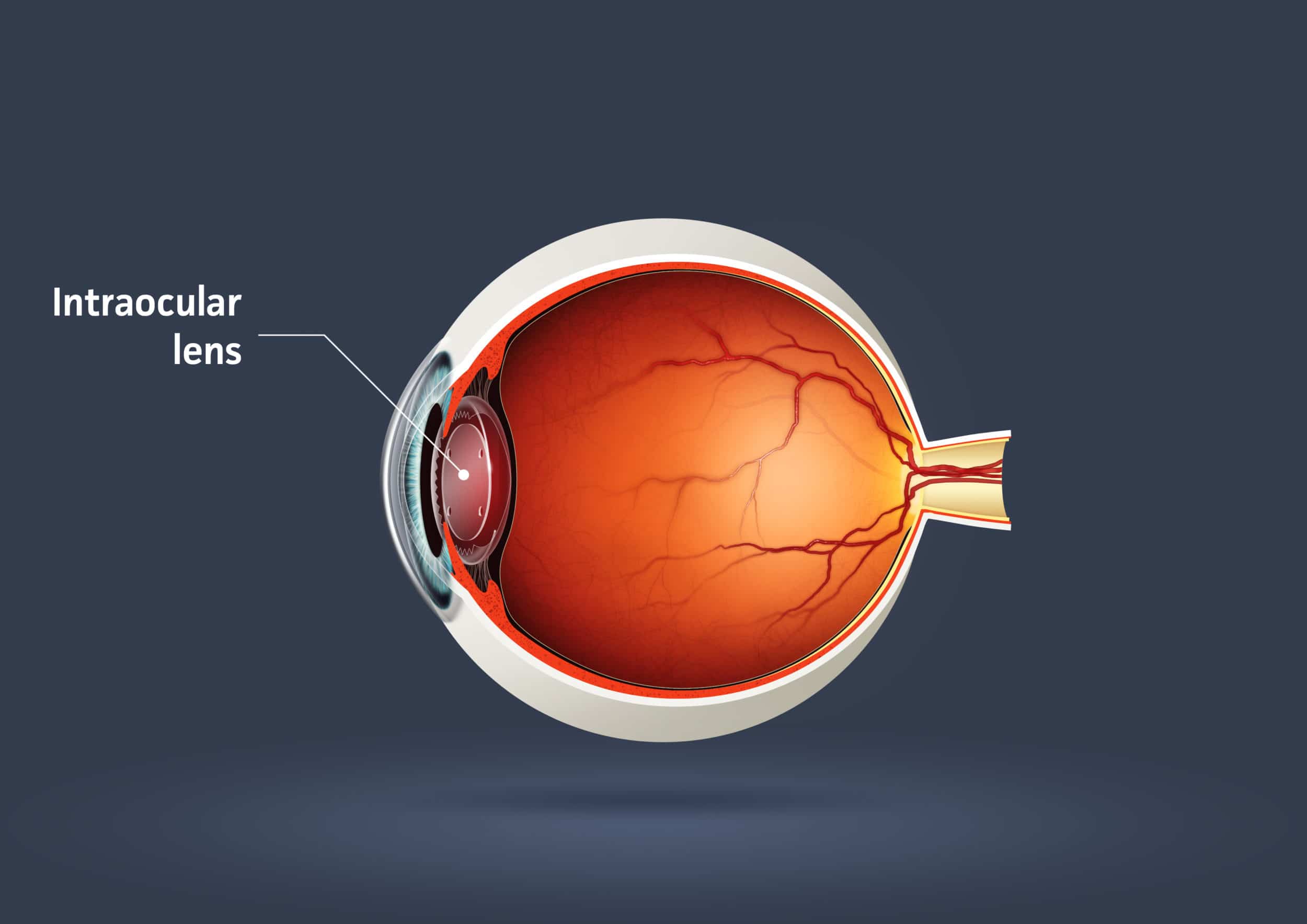 The anatomy of a human eyeball showing where an intraocular lens would be placed