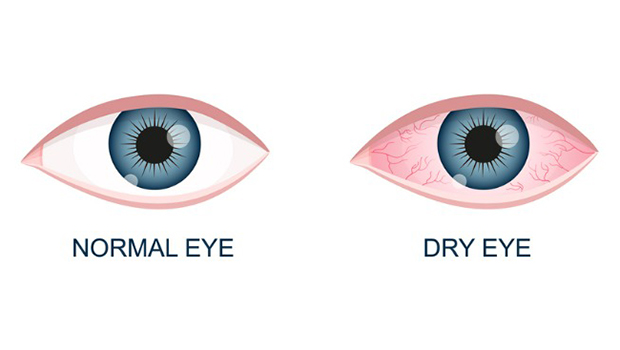 human eye healthy and dry normal and inflamed bloodshot eyeball with vector id1369438035