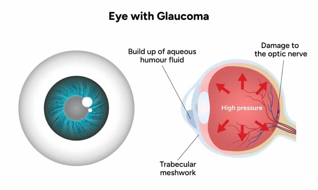 Diagram depicts a healthy eye beside an eye with glaucoma and related ocular pressure