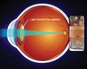 cataractview 300x240Edit
