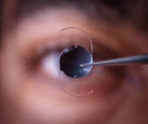 Intraocular lens (IOL) being implanted during cataract surgery to replace the eye's cloudy natural lens and restore clear vision.